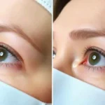 Images of Eyelid Surgery Covered By Insurance Coverage